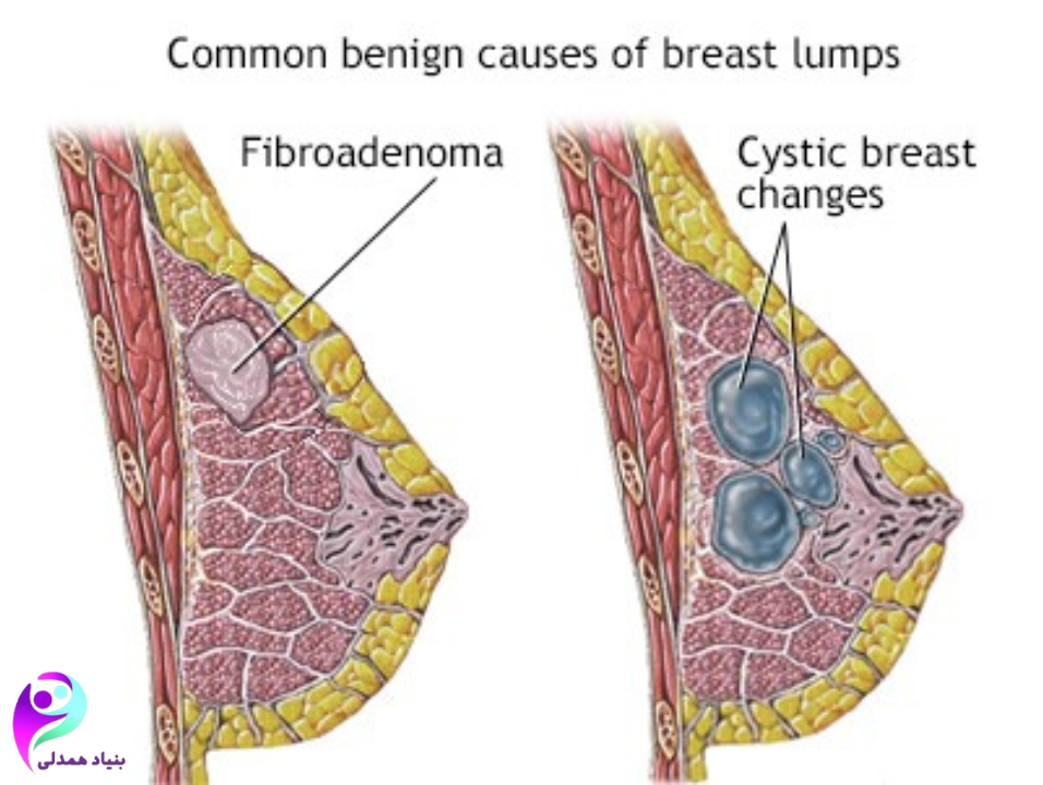 غربالگری پستان چیست