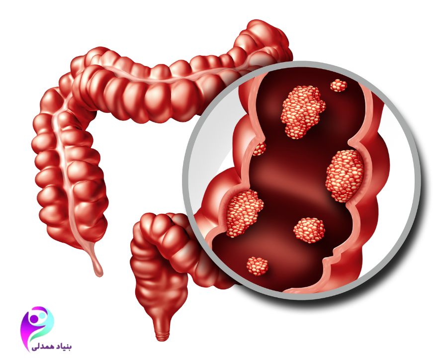 نشانه‌های هشدار دهنده سرطان روده در مردان