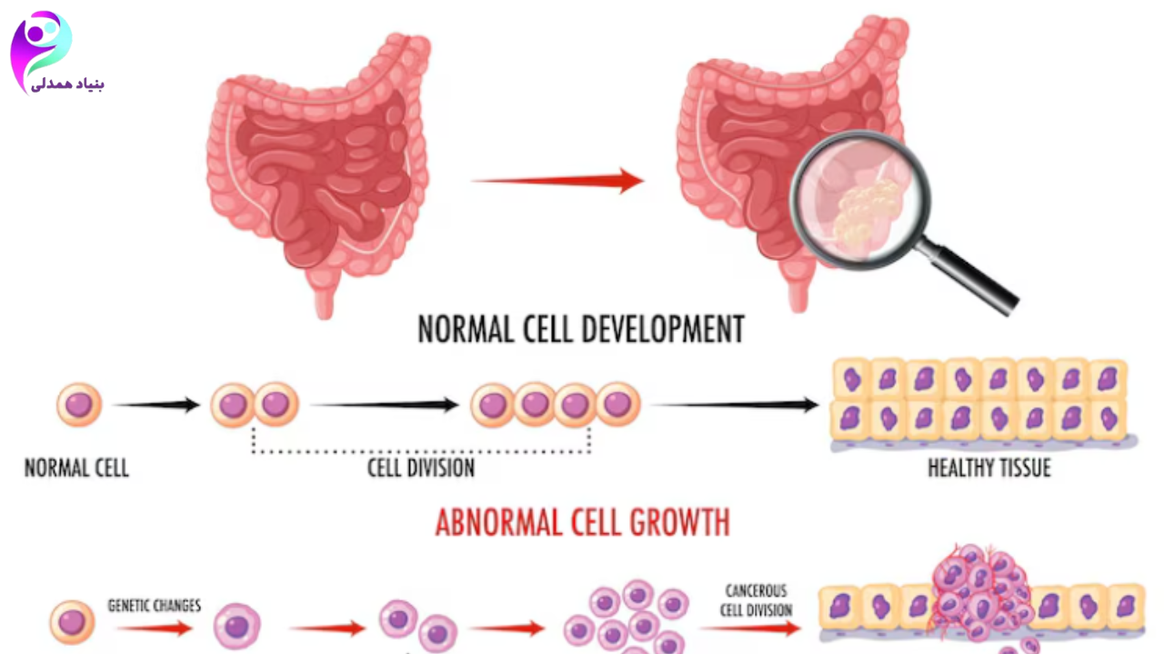 آیا سرطان روده قابل درمان است