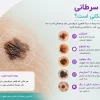 خال سرطانی چه شکلی است