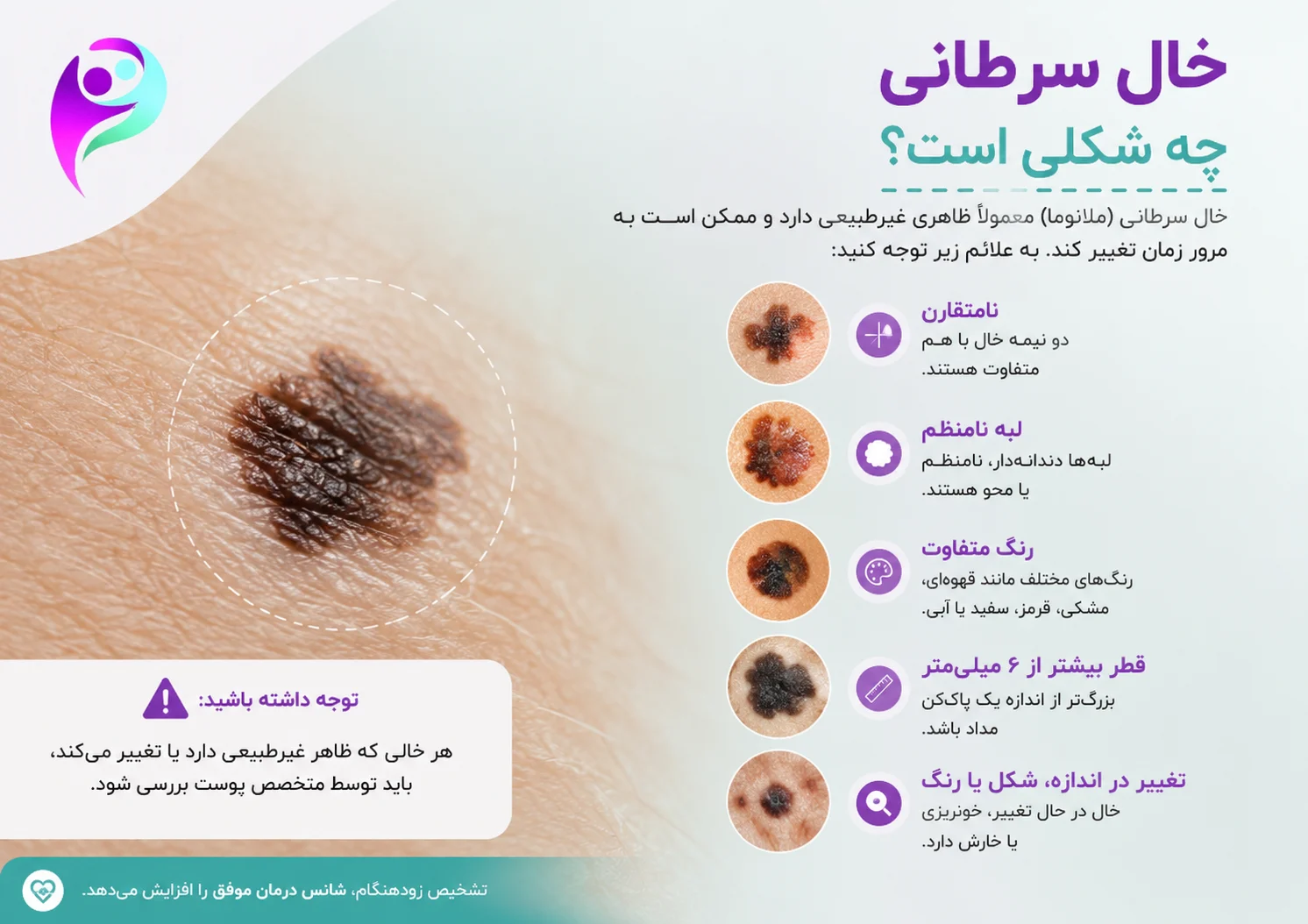 خال سرطانی چه شکلی است