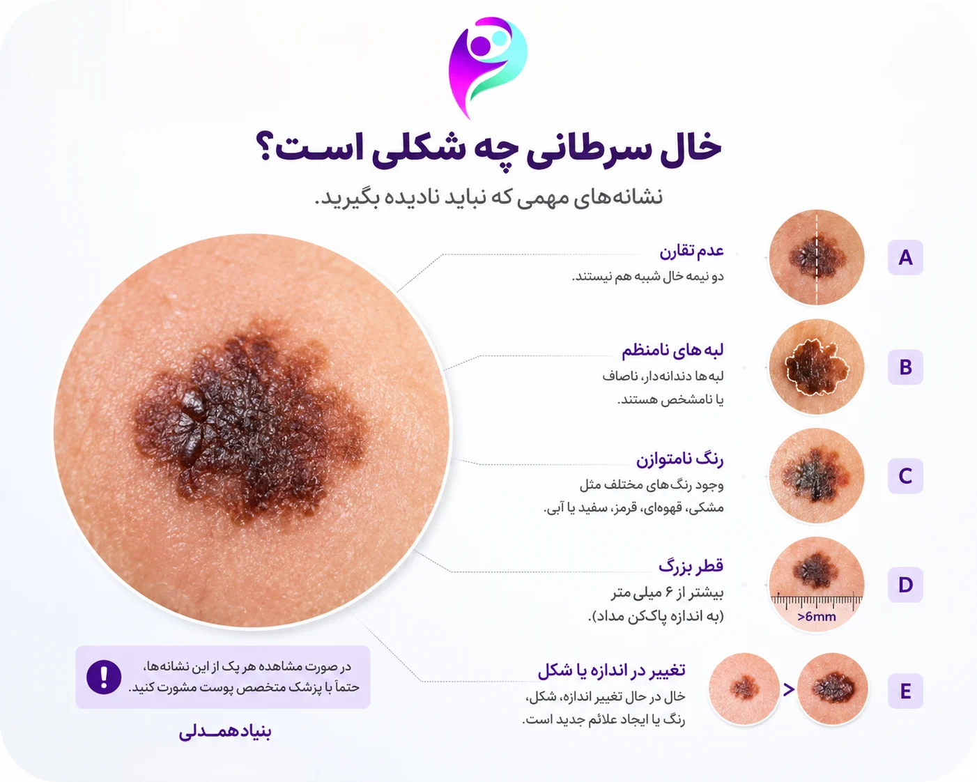 خال سرطانی چه شکلی است