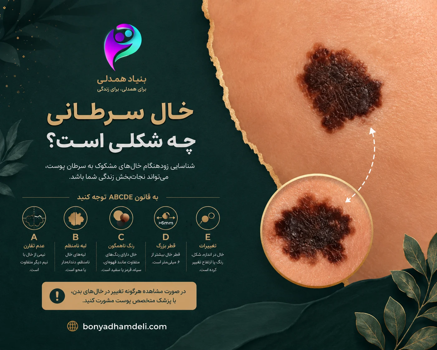 خال سرطانی چه شکلی است