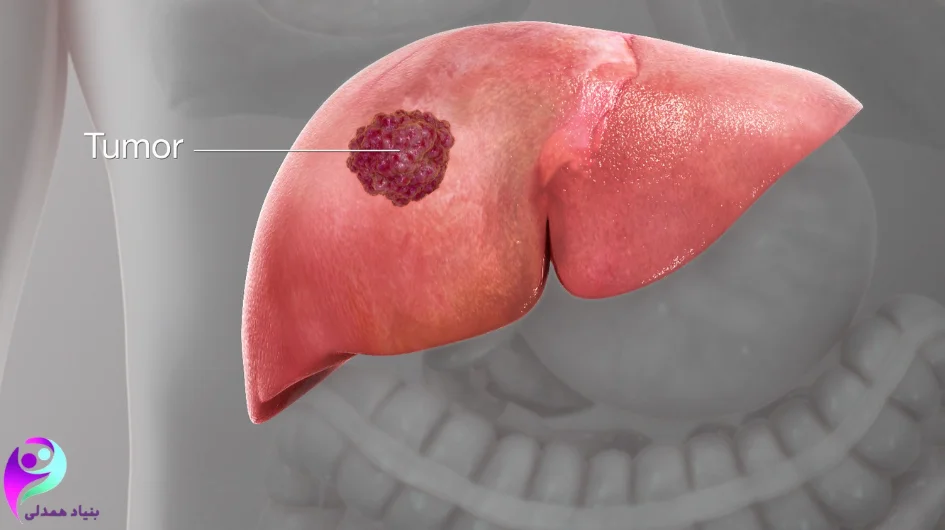 کبد و توده سرطان