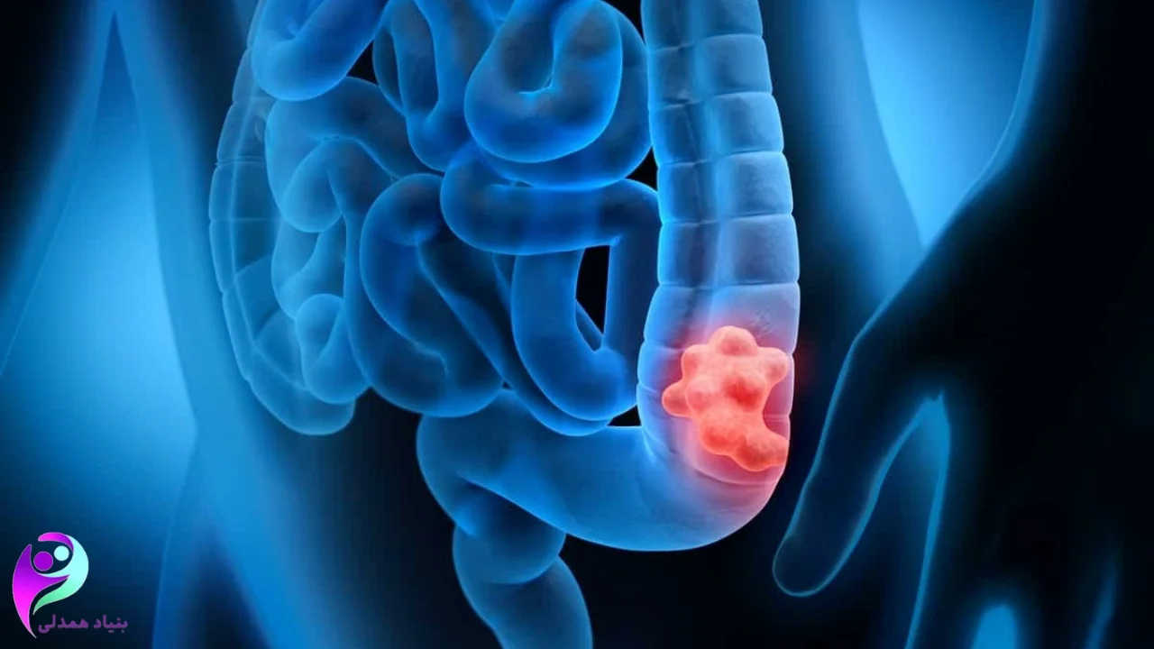 علائم اولیه سرطان روده چیست