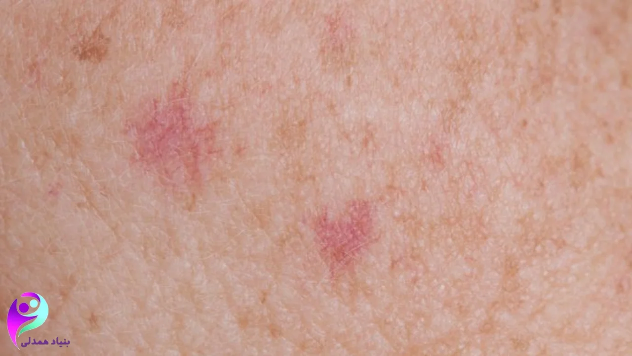 سرطان سلول پایهای