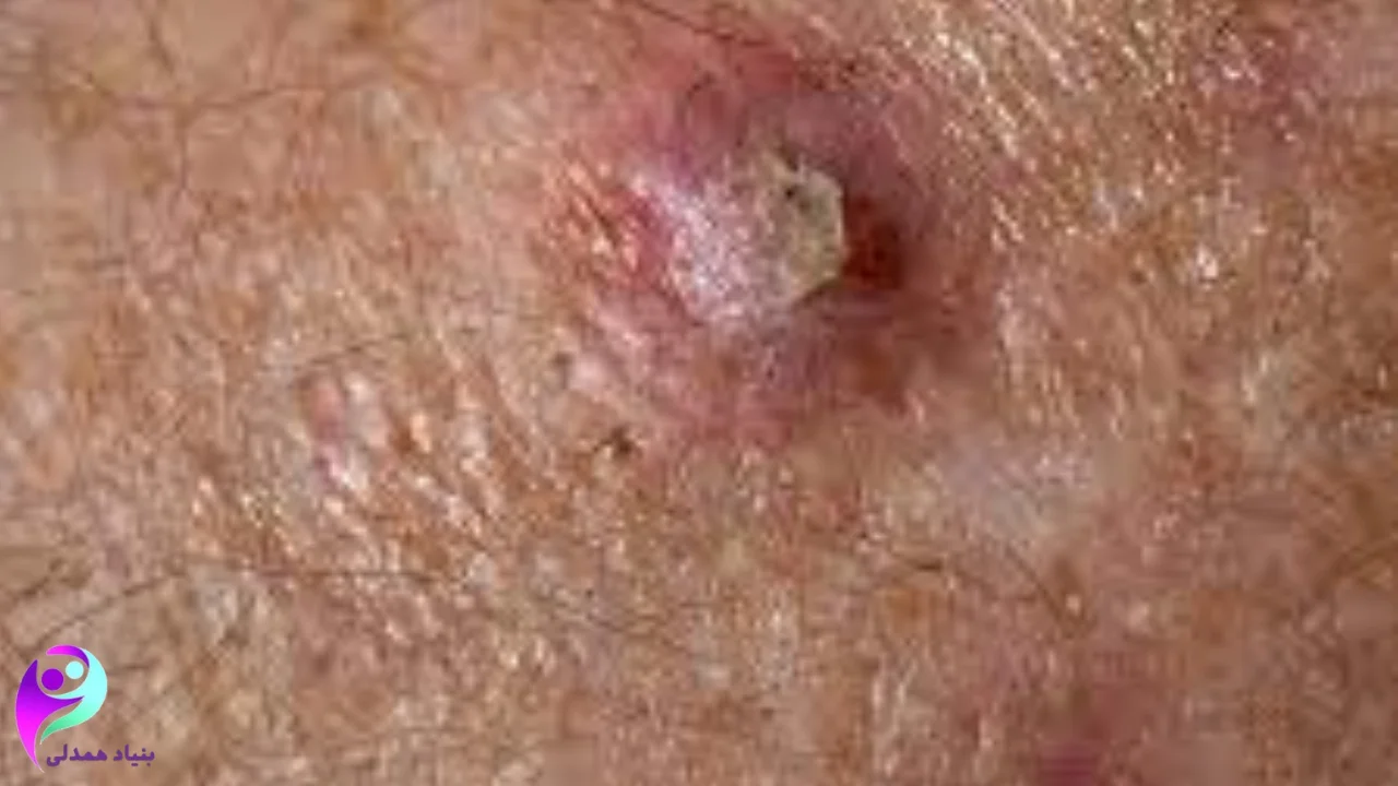 سرطان سلول سنگفرشی