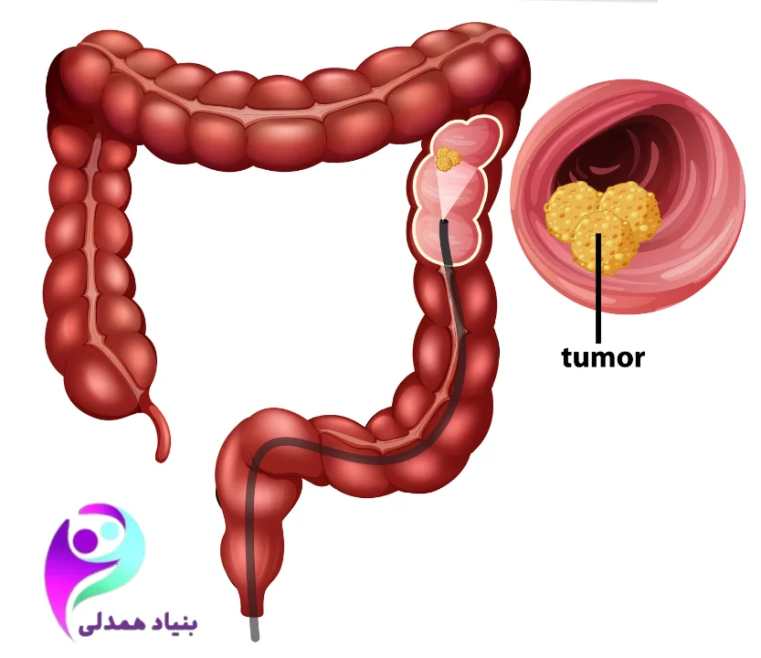تصویر روده بزرگ و توده سرطان