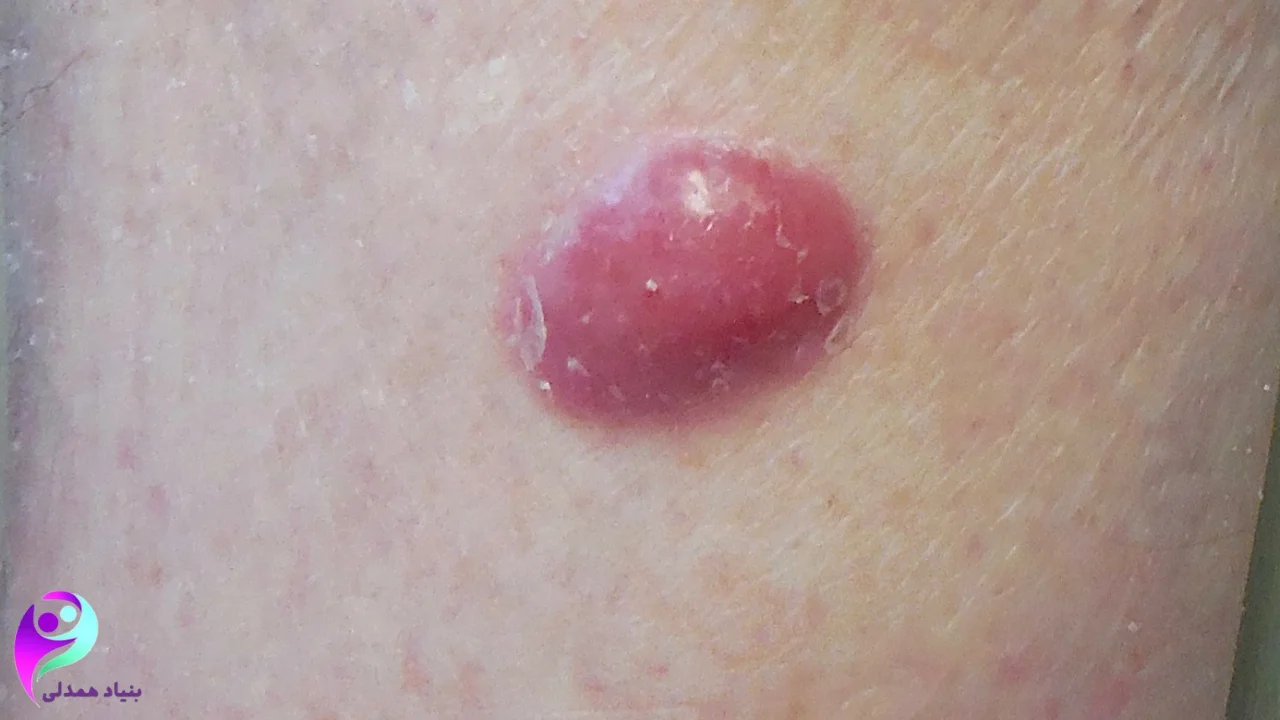 سرطان سلول مرکب