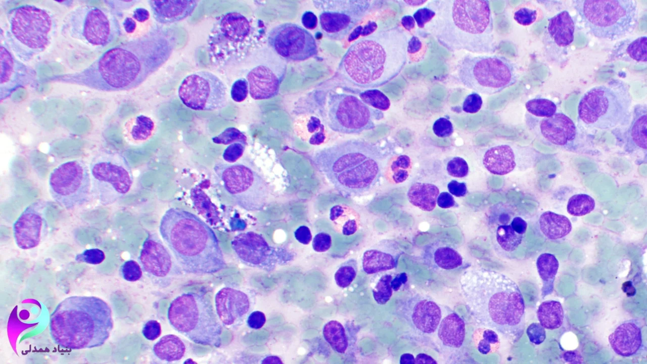 سرطان سلولهای لانگرهانس