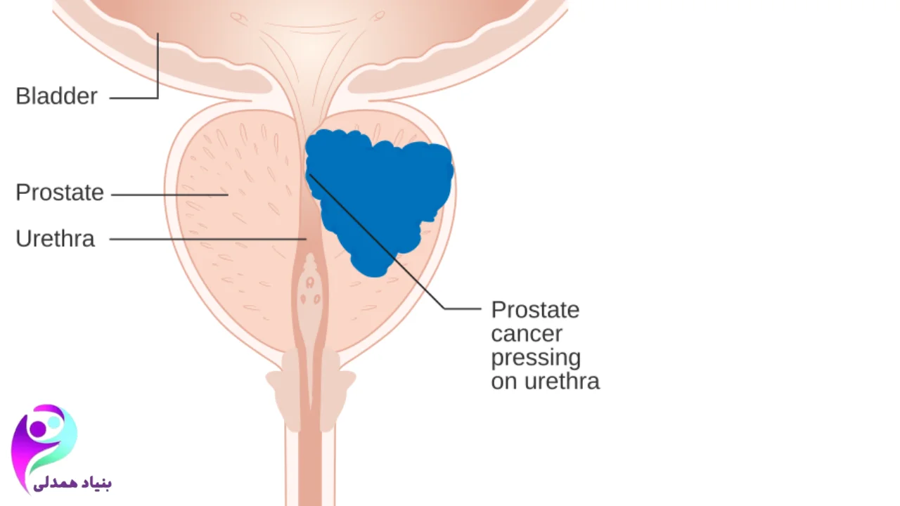 توده سرطان پروستات