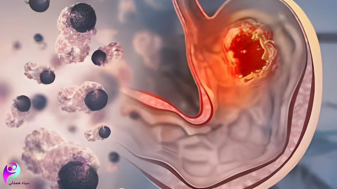 معده و توده سرطانی