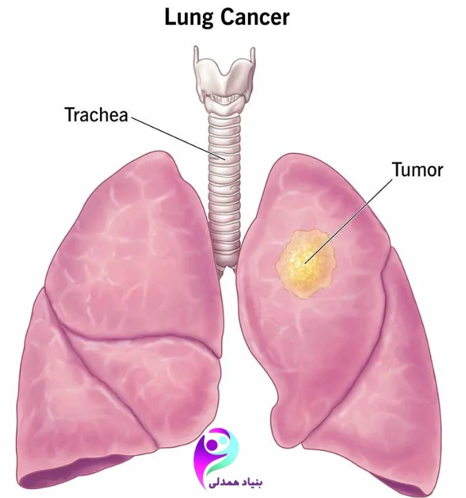 تصویر ریه به همراه توده سرطان