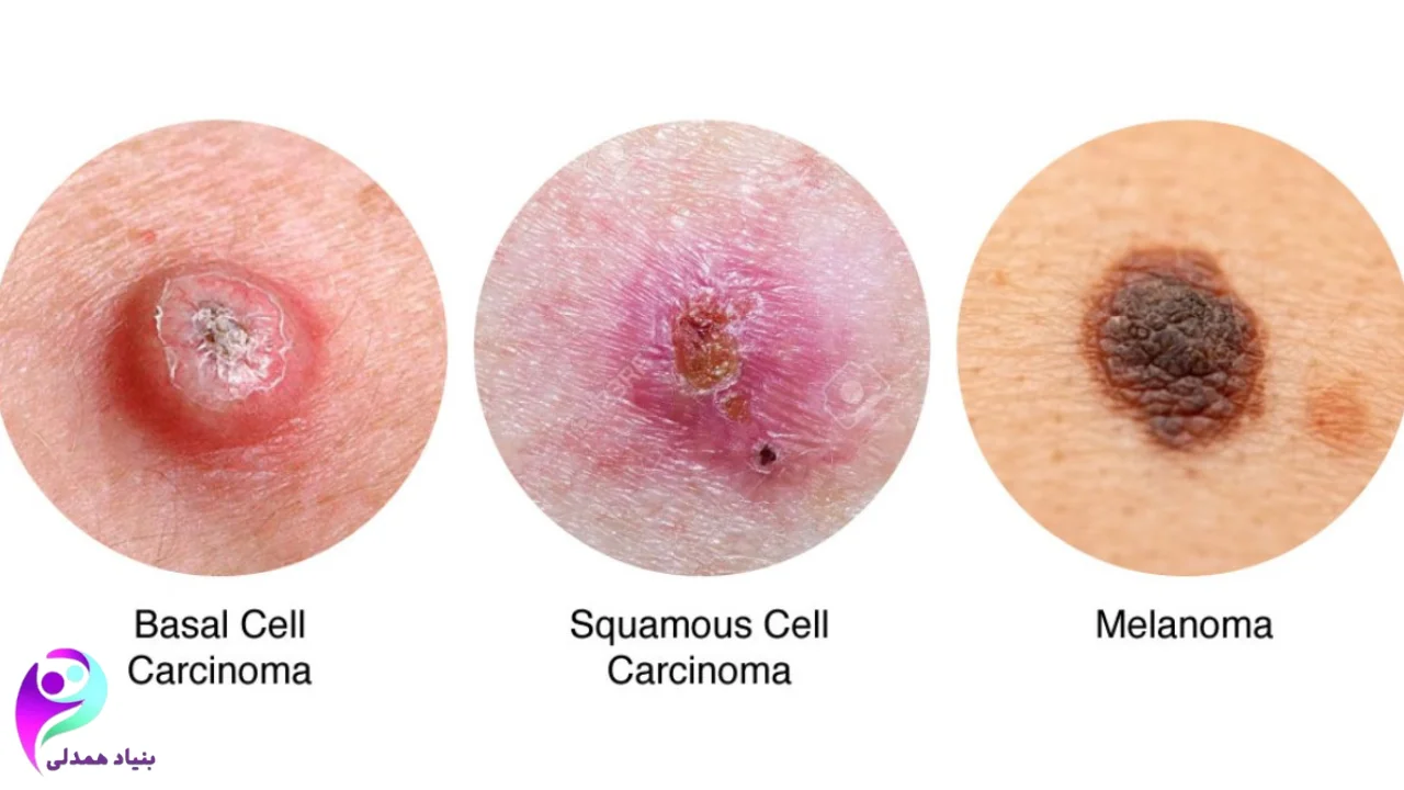 انواع شکل سرطان پوست