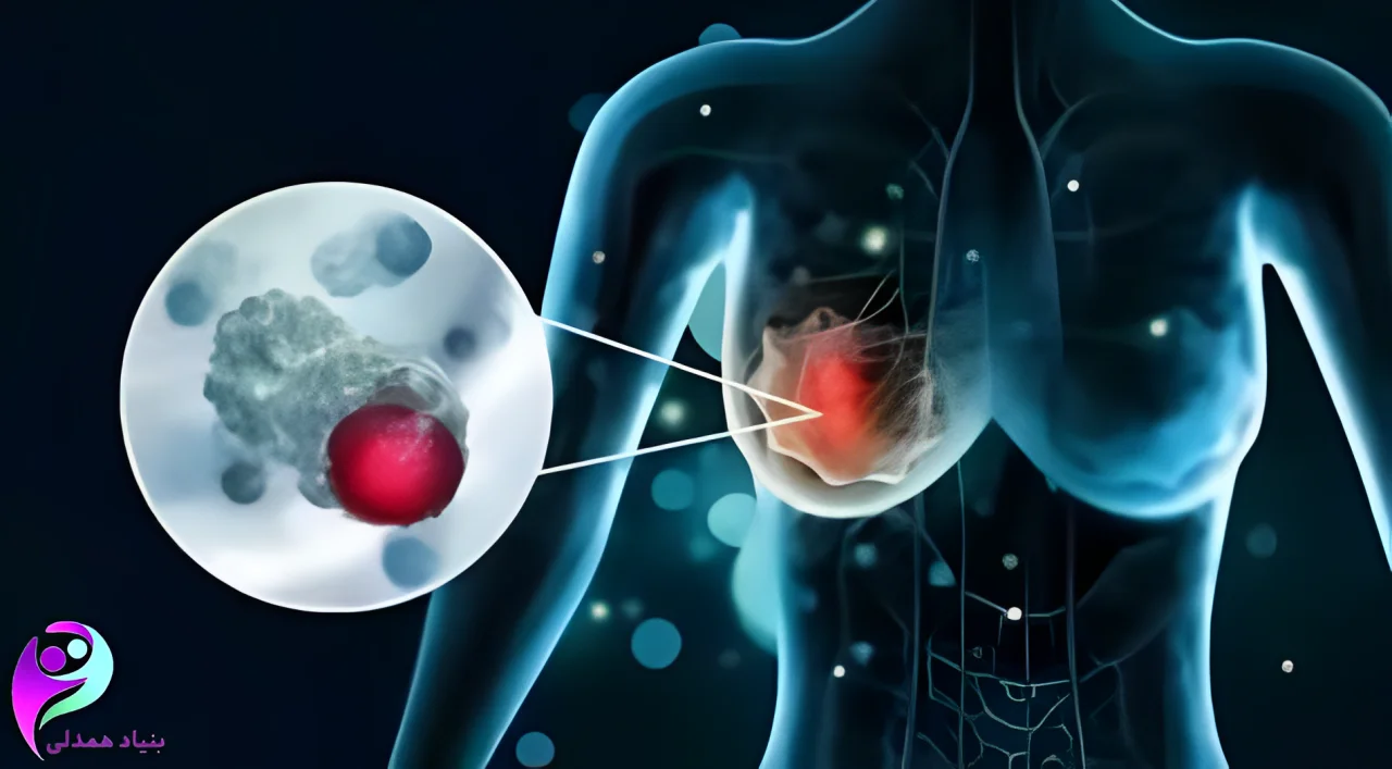 تصویر توده سرطان پستان