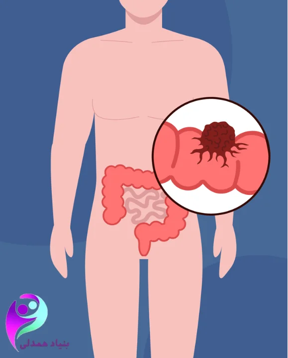 سرطان روده بدخیم در مردان