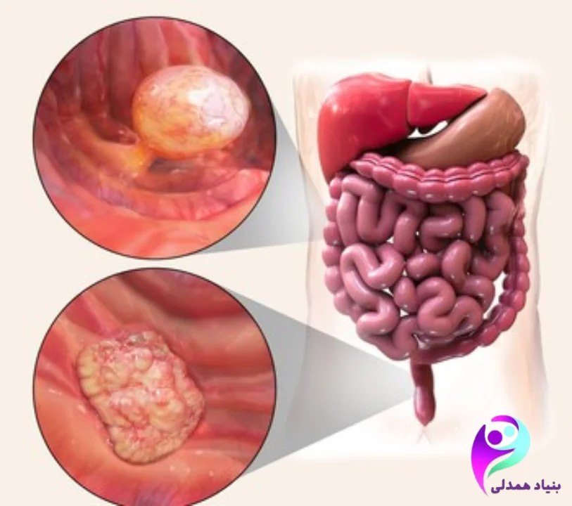 سرطان روده بدخیم در مردان