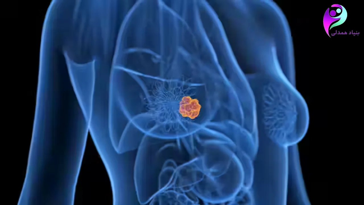 سرطان سینه قابل درمان است