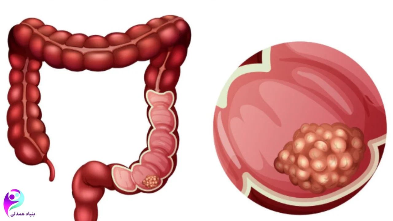 نشانههای سرطان روده در زنان
