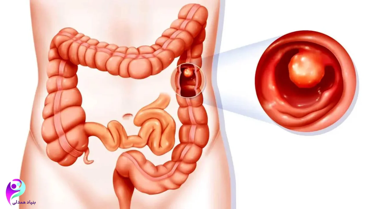 تأثیر ورزش در پیشگیری از سرطان روده